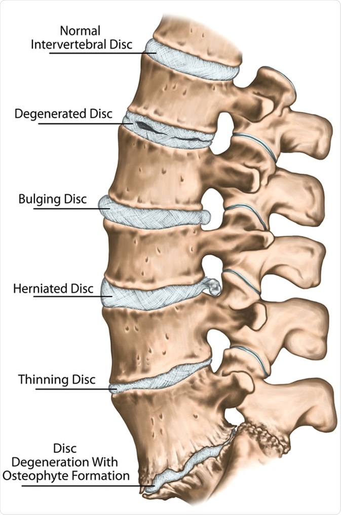 Lumbar Disk Disease
